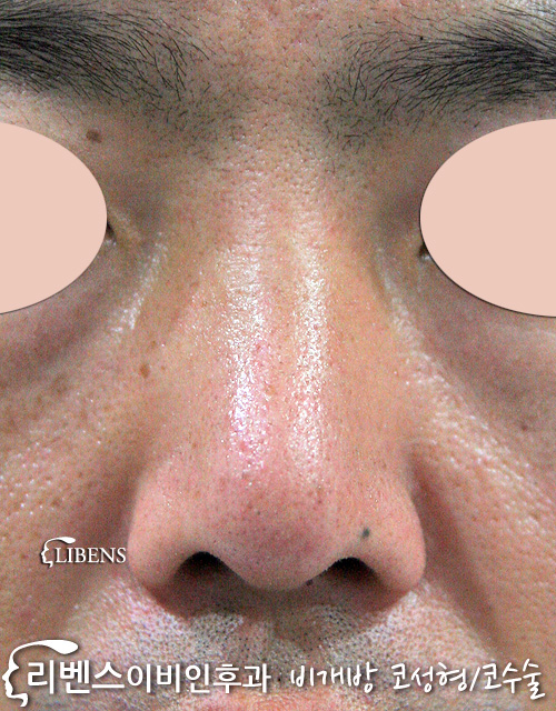 남자 콧대 수술 코끝 복코 높이기 융비술 휜코 비중격 연골 성형 s139